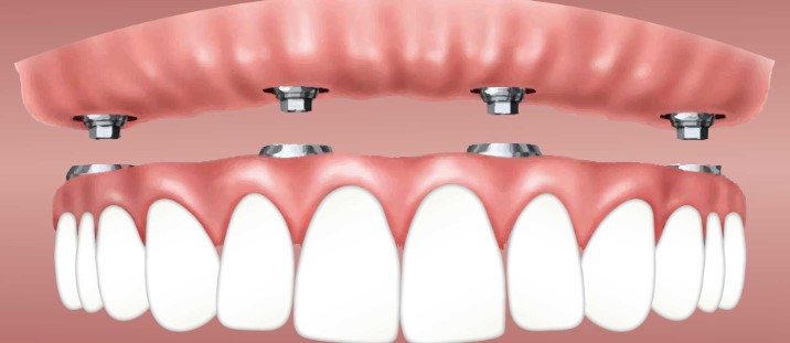 The Ultimate Guide to Dental Implants