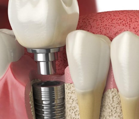 The Ultimate Guide To Dental Implants, Comprehensive Dental Implant Handbook, Complete Dental Implant Manual, Definitive Dental Implant Guide, Authoritative Dental Implant Tutorial, Expert Dental Implant Handbook, AllInclusive Dental Implant Guide, The Ultimate Implant Dentistry Reference, Comprehensive Dental Implant Resource, Complete Dental Implant Encyclopedia, Definitive Dental Implant Compendium, Authoritative Dental Implant Reference, Expert Dental Implant Compendium, AllInclusive Dental Implant Encyclopedia, The Ultimate Tooth Replacement Guide, Comprehensive Tooth Implant Handbook, Complete Tooth Implant Manual, Definitive Tooth Implant Guide, Authoritative Tooth Implant Tutorial, Expert Tooth Implant Handbook, AllInclusive Tooth Implant Guide, The Ultimate Dental Restoration Reference, Comprehensive Dental Reconstruction Handbook, Complete Dental Restoration Manual, Definitive Dental Reconstruction Guide